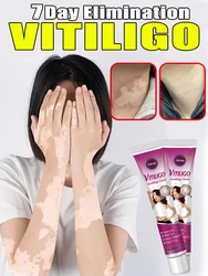 Vitiligo Treatment Cream Melanin Growth Ointment Fast Remove White Spot