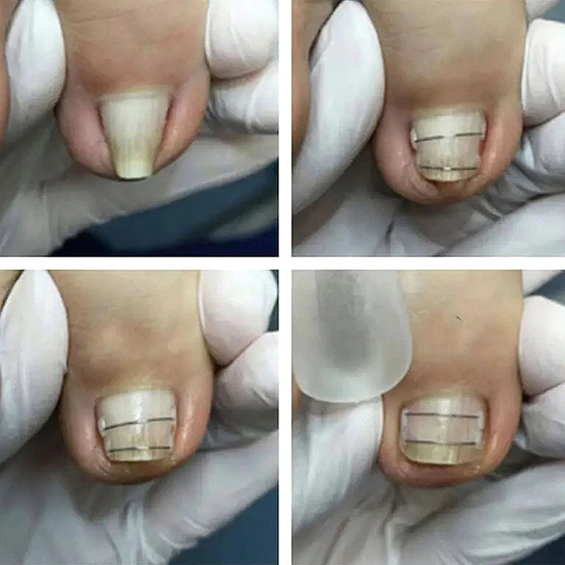 Ingrown Toenail Corrector Tools Pedicure Recover Embed Toe Nail Treatment Professional Ingrown Toenail Straightening Clip Brace.