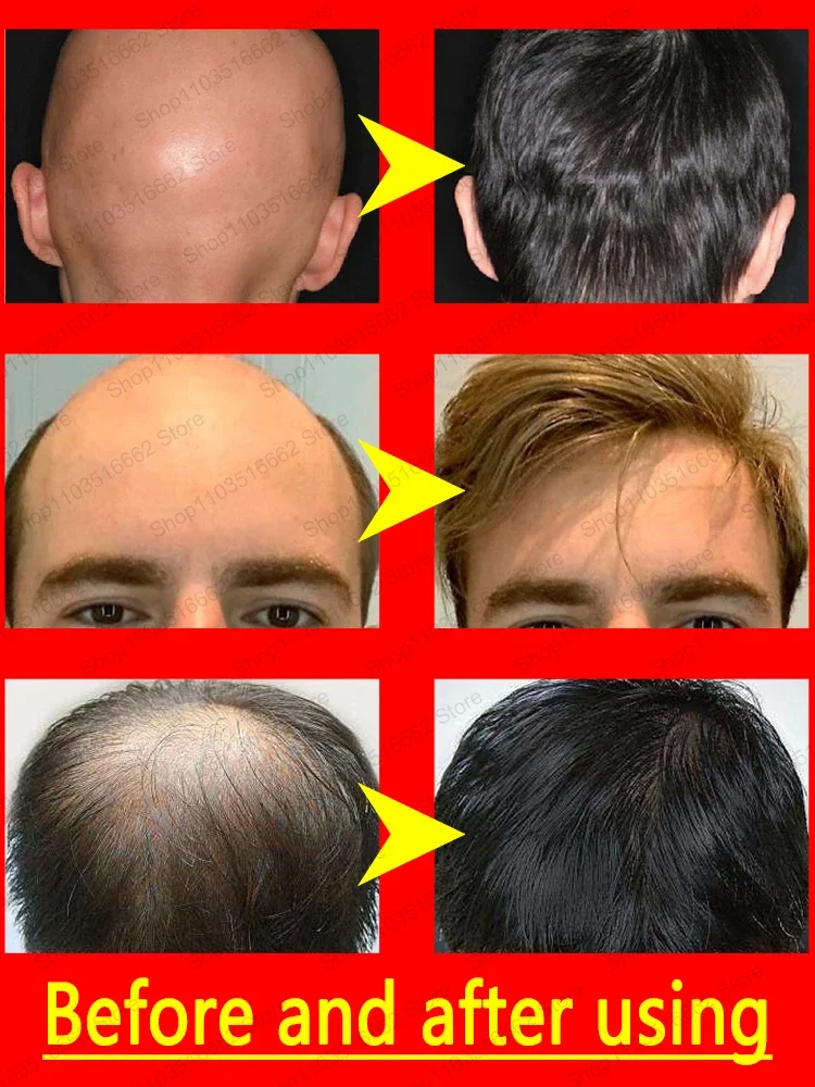 Hot selling hair growth products, fast, help, hair, grow. Fix hair loss, fix baldness.