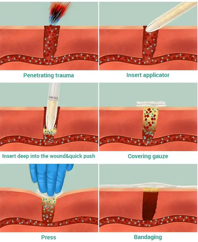 Imagem -02 - Quitosan pó Aplicador com Rápido Hemostático Grânulo Bandagem Cuidados Médicos para Kit de Sobrevivência de Emergência Tático Uso Externo 6g