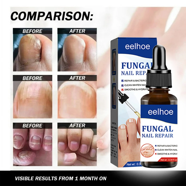 Fungal Nail Treatment Oil Foot Repair Essence Toe Nail Fungus Removal Gel Anti Infection Cream Fungal Nail Removal 10ML