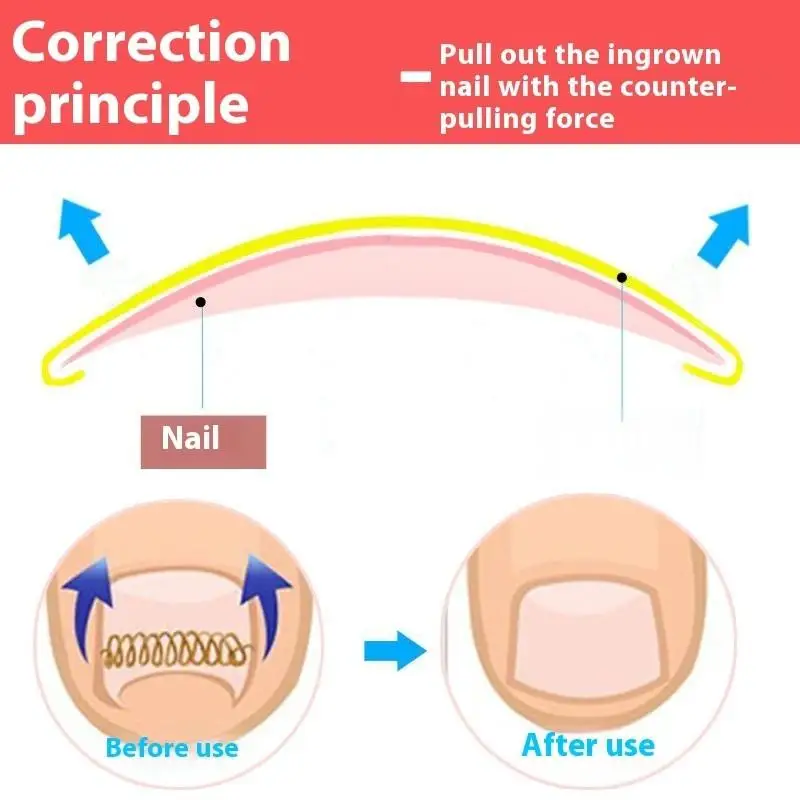 Ingegroeide Teennagel Corrector Gereedschap Pedicure Herstellen Embedden Teen Nagel Behandeling Professionele Ingegroeide Teennagel Correctie Voet CareTool