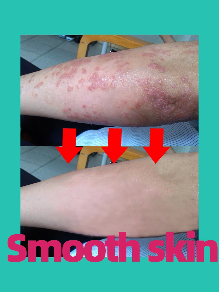 psoriasis ointment cream