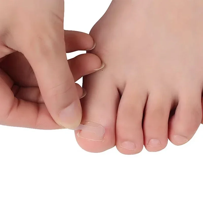 Traitement des ongles incarnés, outil de Correction des ongles incarnés, Patch élastique autocollant, Clip de redressage, attelle, outils de pédicure, 10 pièces