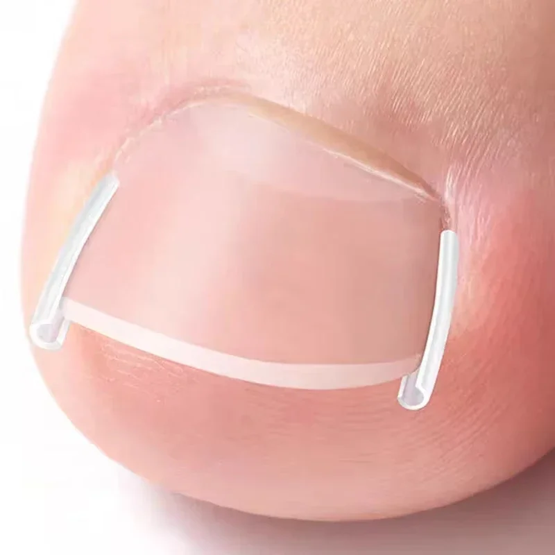 50Pcs Ingrown Toenail Correction Tool Invisible Ingrown Toe Nail Treatment Pad Groove Straightening Clip Brace Foot Care Tool