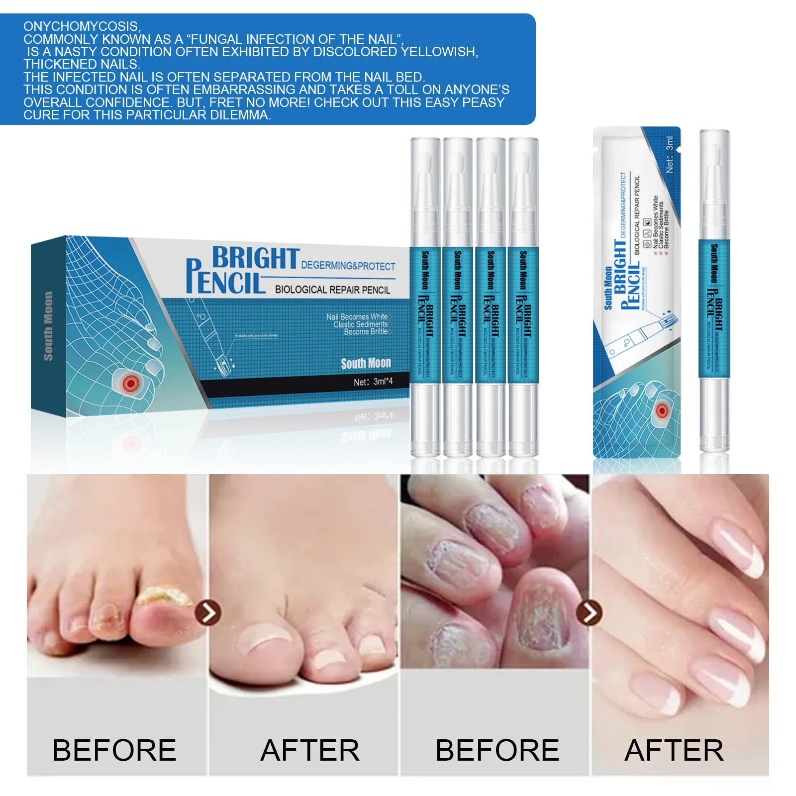 Nail repair pencil Fungal Treatment Feet Care Essence Polish Oil Antifungal Drops Removes essential oil