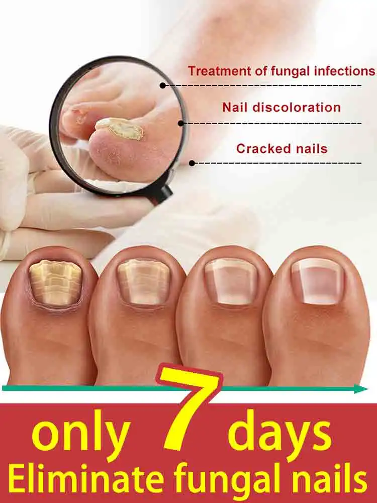 

Laser Product For Solving Nail Problems