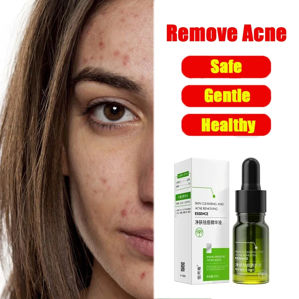

Deeply Hydrating Acne Remover Face Serum - Repair, Moisturize, Pimple Removal, Pore Shrinkage, Oil Control Skincare