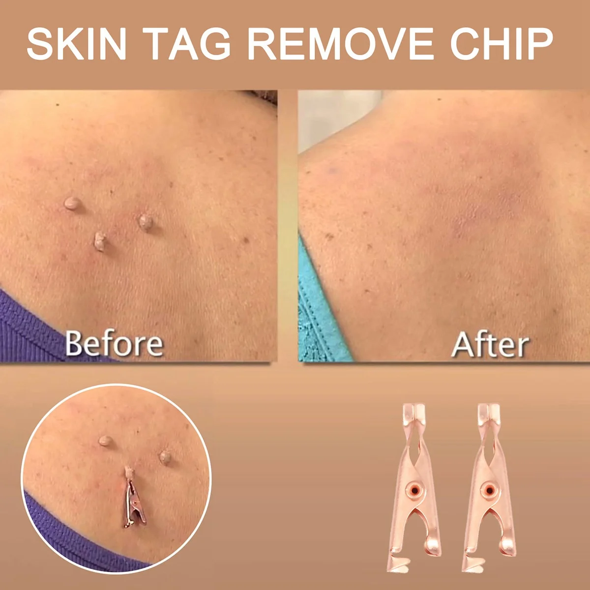 AT29-1 Box/12Pcs Copper Skin Tag Remover Clips Wart Tag Extractor Copper Tag Out Skin Tag Removal Tool