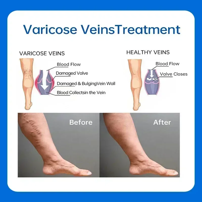 Effectieve variceale verlichtingscrème wordt gebruikt voor de behandeling van spataderen om vasculitis, flebitis te verlichten