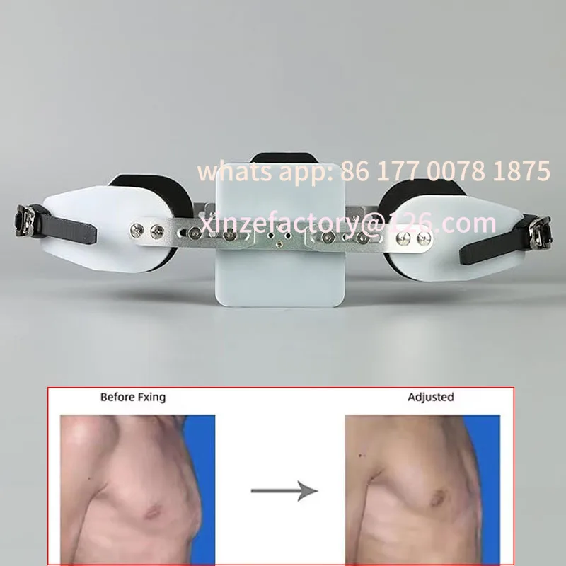 Customizable Adjustable Pectus Carinatum Orthosis Brace Pigeon Chest Orthosis Support Ribs Valgus Orthosis Braces Kids Adults