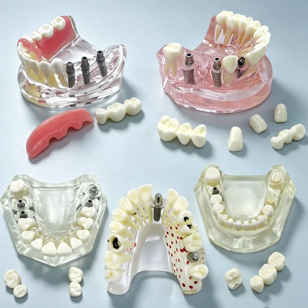 Multi-Type Dental Implant Demonstration Model Removable Crown Bridge Single Teeth Study Teaching Model Dentistry Lab Products