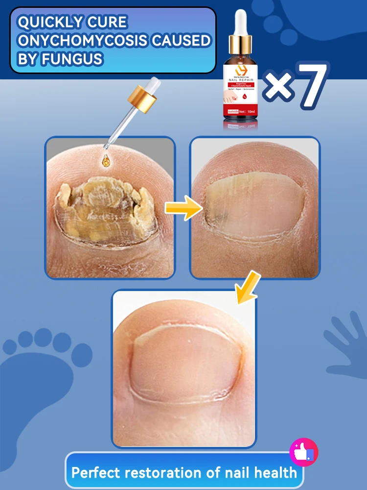 Resolver todos os problemas de fungos nas unhas