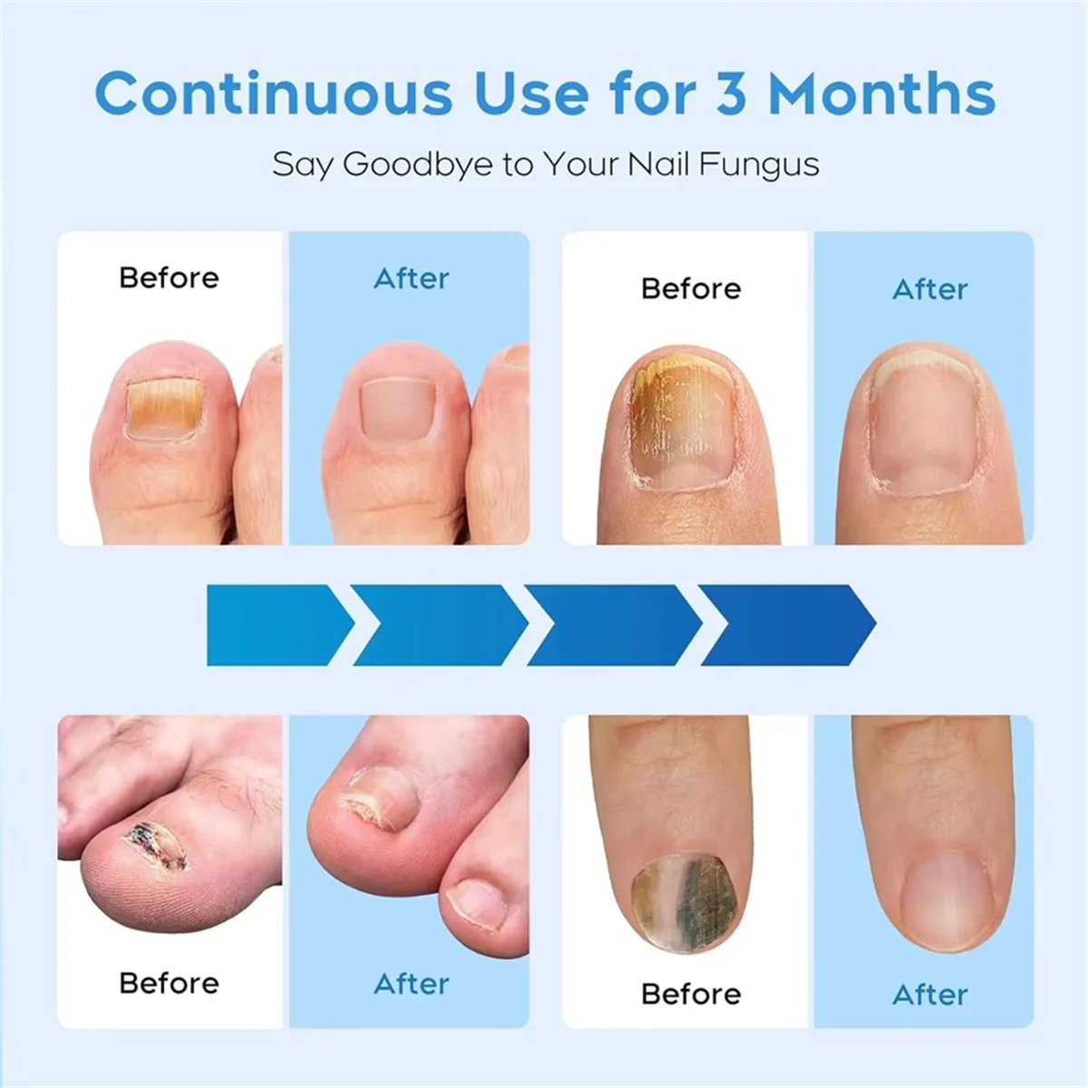 BABQ Dispositivo de tratamiento láser para hongos en las uñas, tratamiento de hongos en las uñas, onicomicosis, elimina eficazmente la onicomicosis, crecen las uñas de los pies
