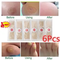 6PCS Corn Patch Corn Plaster Remover Corn Toe Pads Patch Adhesive Callus Cushion Non-woven Fabric Toe Corn Callus Removal