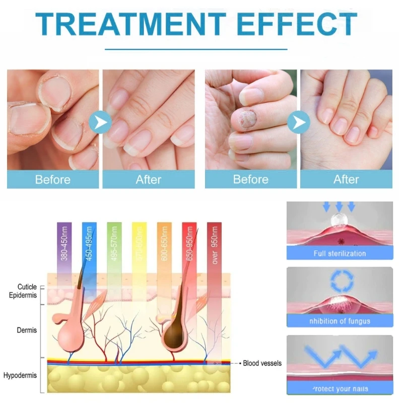 Fungi Lasers Device Fungi Cleaning Lasers Device for Nail Therapies