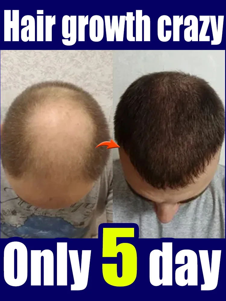 

98% of customers repurchase, have more and more hair, say goodbye to baldness