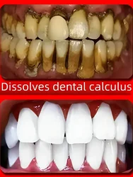 Dentifrice blanchissant au fluorure pour les dents, calcul dentaire, élimination des odeurs buccales, prévention temporaire de la parodontite