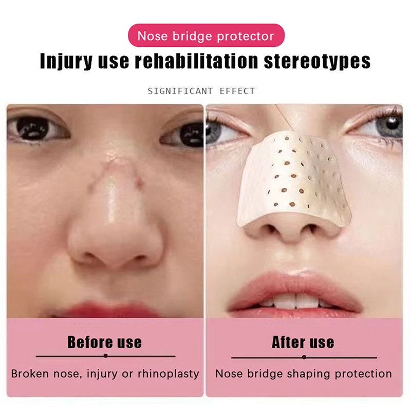 Self-shaping Nose Splint Low Temperature Thermoplastic Nose Job Adhesive Tape Fracture Splint Provide External Support Fixation