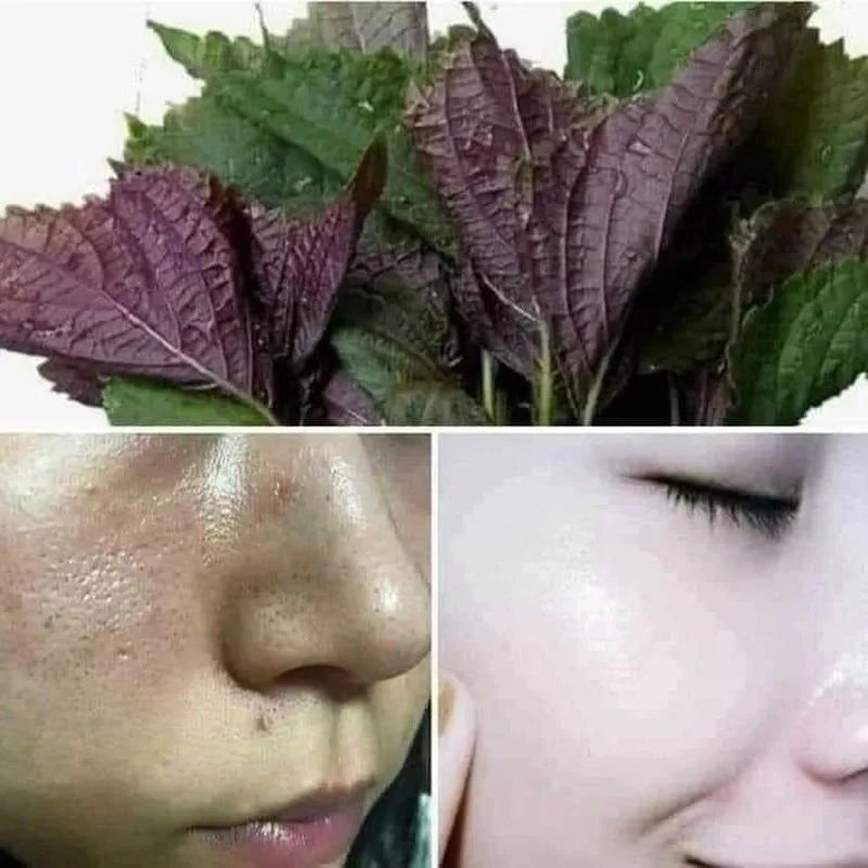 Vietnam Freckle Removing, Whitening And Brightening Repair Clean Skin, Mat Na Tia To DH Skin Giup Ngua Mun Tham Duong Trang Da