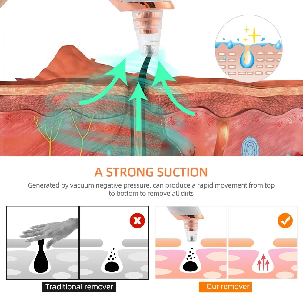 にきびやにきび用の電気掃除機,掃除機,掃除機,強力な毛穴,にきび,洗顔料,スキンケアツール