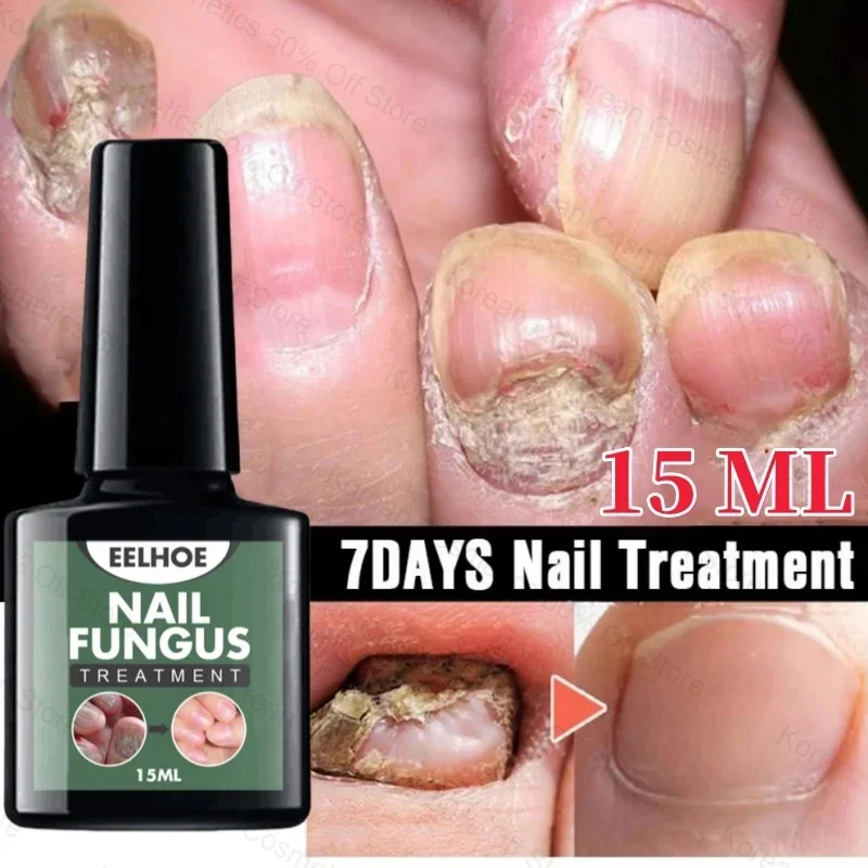 

7 Days Nail Fungal Treatment Essence Oil Foot Toe Nail Fungus Removal Serum Repair Toenail Onychomycosi Gel Anti Infection Care