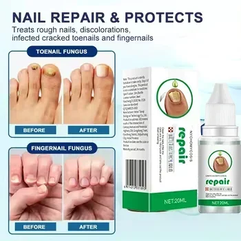 

Fungal Nail Treatment Essence Oil Nail Fungus Repair Toenail Fingernail Treatment Onychomycosis with Mushrooms