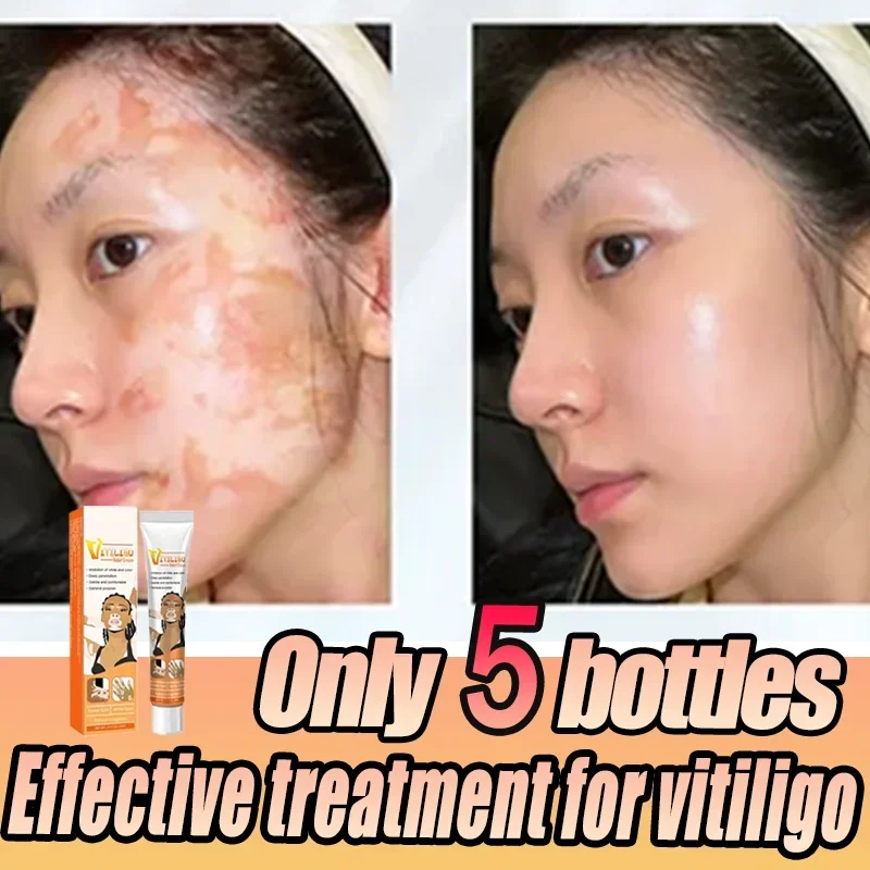 White Spot Antibacterial Cream Skin Care Vitiligo Leukoplakia Treatment Melanin Promoting Vitiligo Cream Skin Health Care