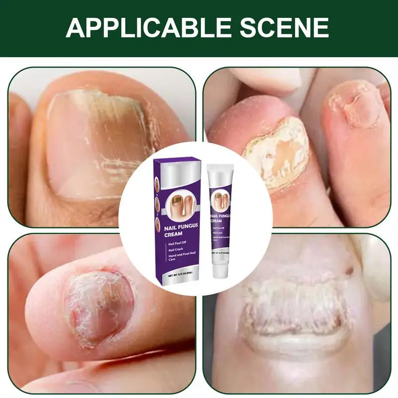 Nail Repair Cream Nail Ointment Toenail Strengthener Promotes Healthy Growth Gentle Nail Strengthening Targets Splitting Weak