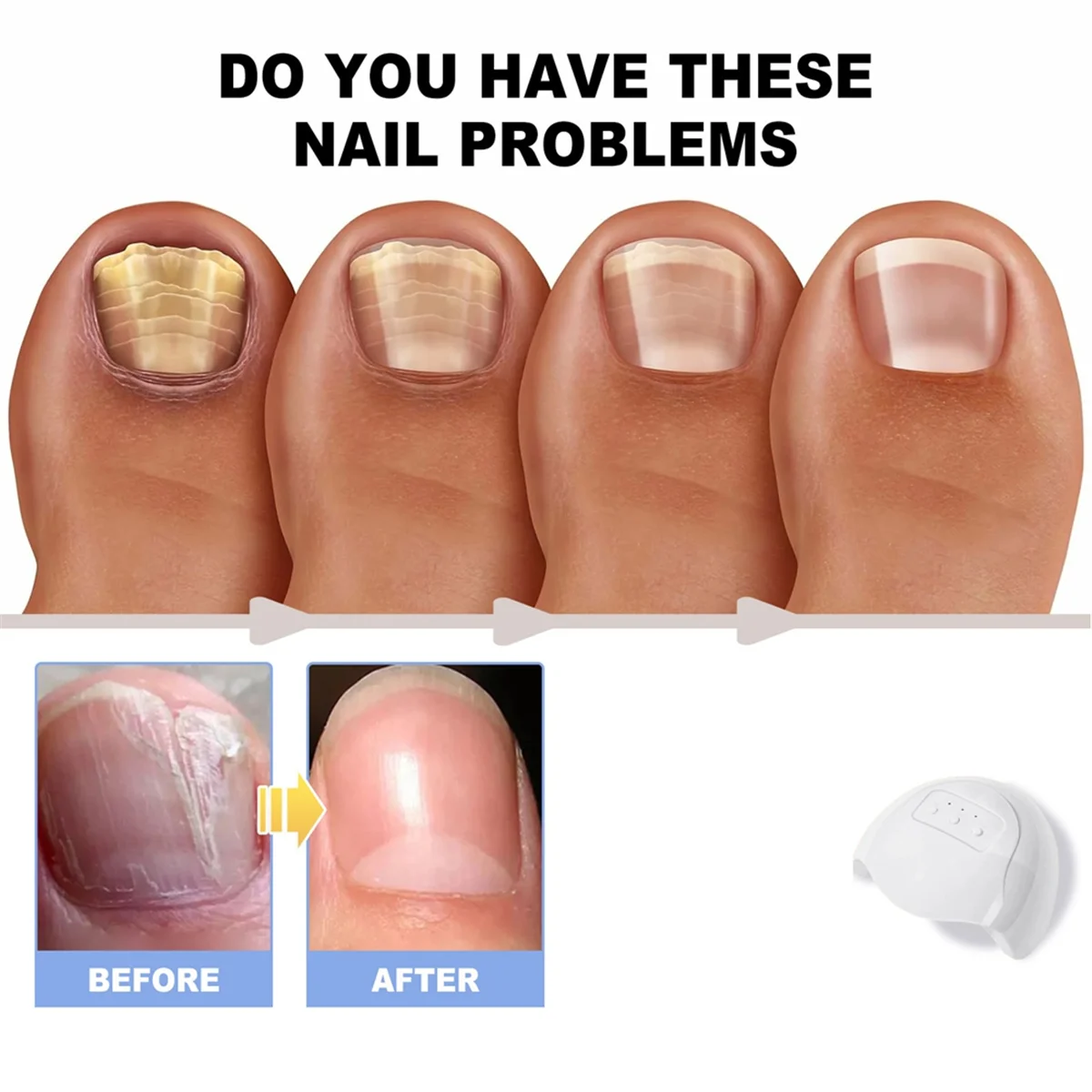 الليزر لجهاز علاج فطريات الأظافر تنظيف فطار الأظافر الفطرية إصلاح القدم الفطريات إزالة الأظافر مكافحة الفطر #6