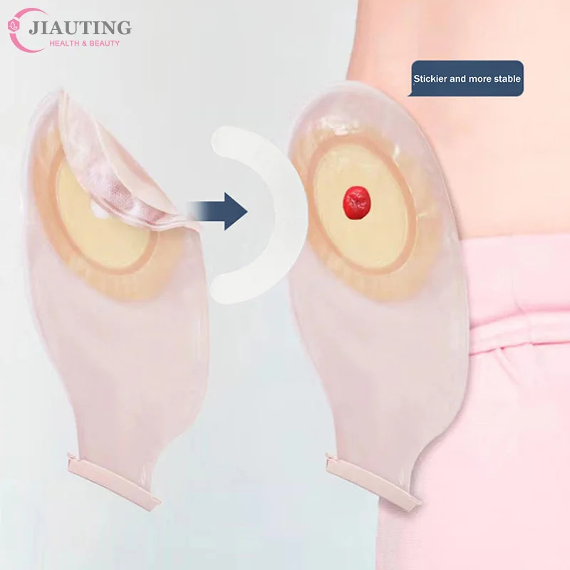 

10 шт., барьерные полоски для стомы, ленты, кольца, клейкие фиксаторы давления, герметичные колостомы, сумка для колостомы, барьерная полоса