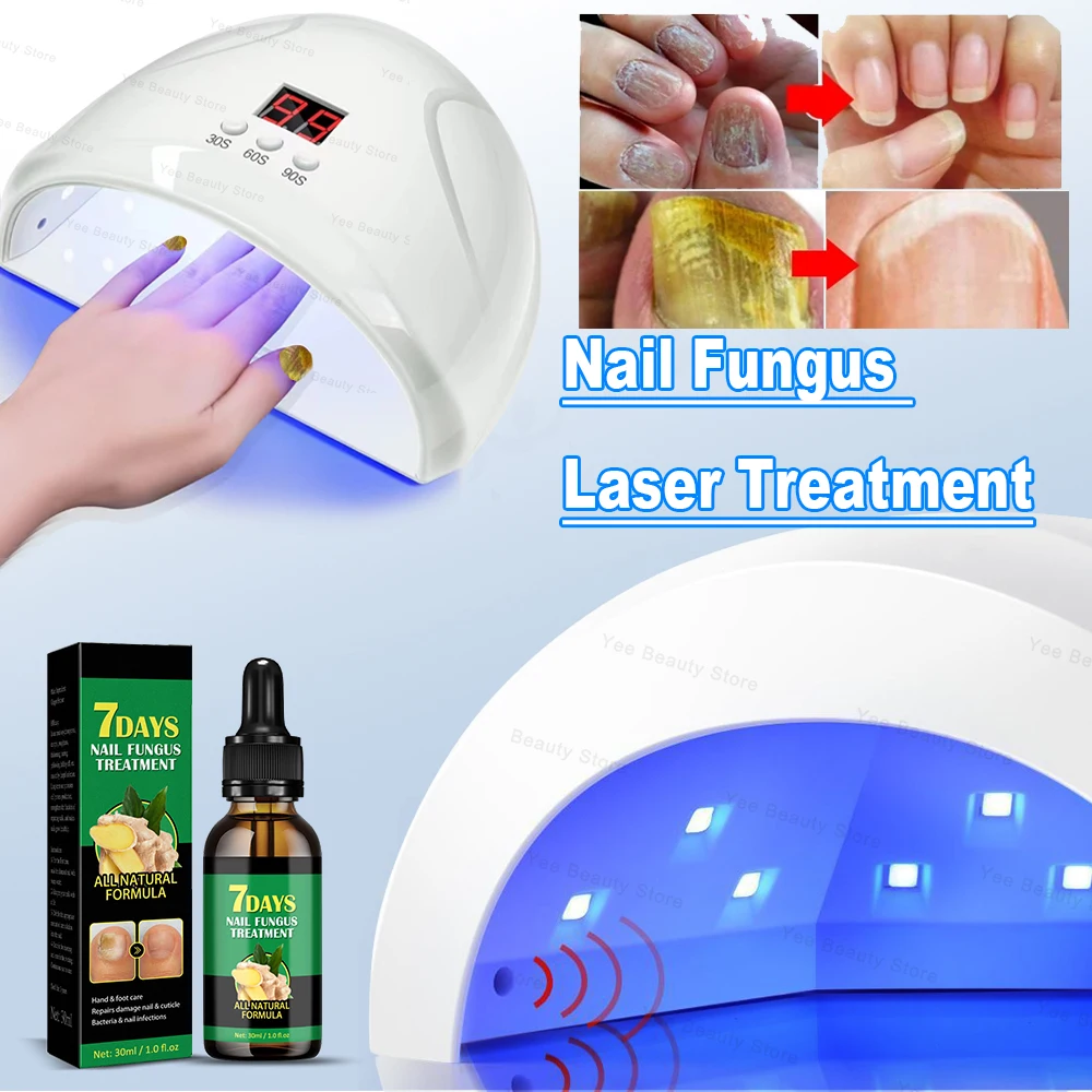 Toenai Fungal Device Repair Fast Toenail Laser Nail Fungus Onychomycosis Repair Toenail Fingernail Removes Nail Fungus Treatment