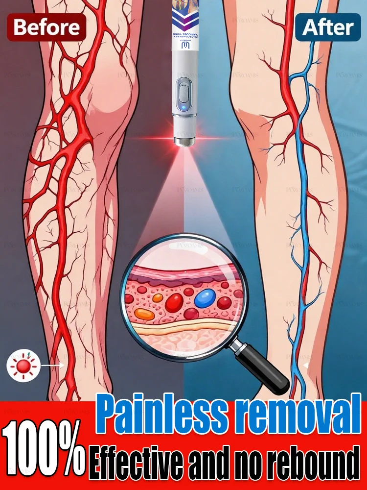 

Tʜɪʀᴅ ɢᴇɴᴇʀᴀᴛɪᴏɴ ᴠᴀʀɪᴄᴏsᴇ ᴠᴇɪɴ ʟᴀsᴇʀ ᴇʟɪᴍɪɴᴀᴛᴇs ᴠᴀsᴄᴜʟɪᴛɪs ᴀɴᴅ ᴘʜʟᴇʙɪᴛɪs, ʀᴇʟɪᴇᴠᴇs sᴘɪᴅᴇʀ ʟᴇɢ ᴘᴀɪɴ, ʟᴀsᴇʀ ᴘᴏɪɴᴛᴇʀ ᴛʜᴇʀᴀᴘʏ