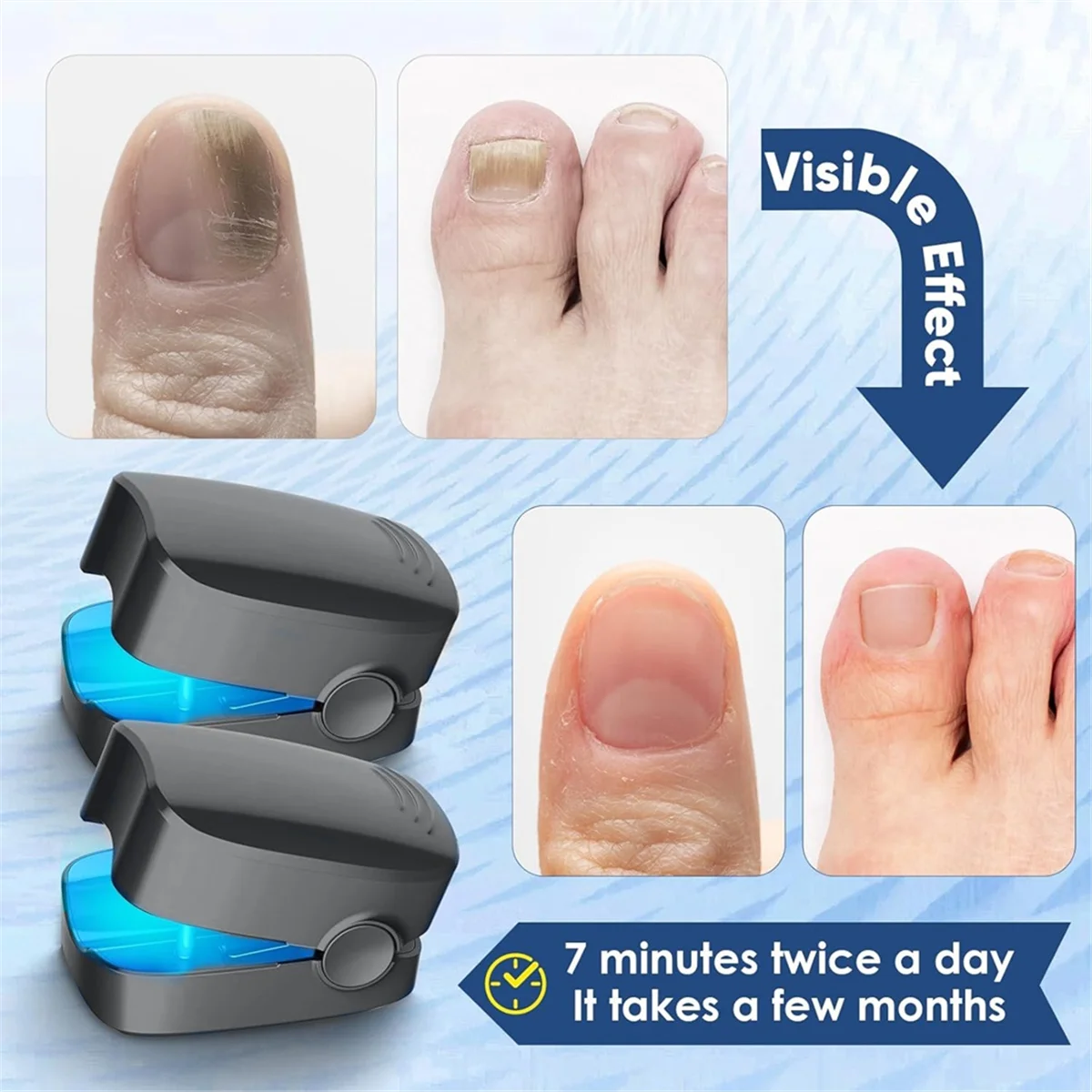 Lampu pembersih Fungu, perawatan Fung kuku untuk onychcoomysis sangat efektif untuk jari/kuku kaki C