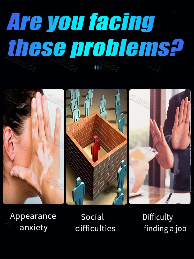 Caneta de luz azul remove rapidamente o vitiligo, uma ferramenta mais vendida para cuidados com a vitiligo.