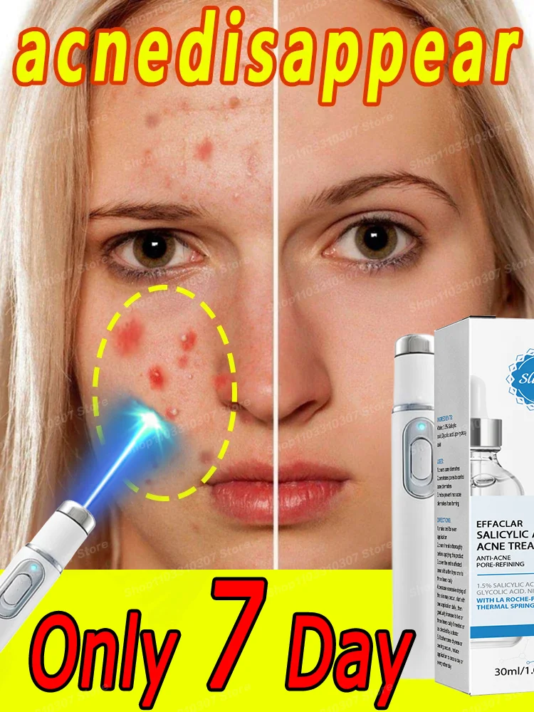 

Acne Cream Remedy Anti Pimple Marks Serum