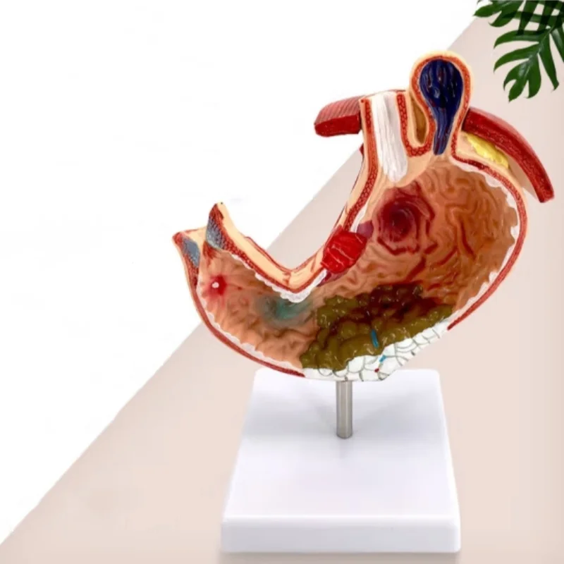 

High-quality anatomical model of diseased stomach