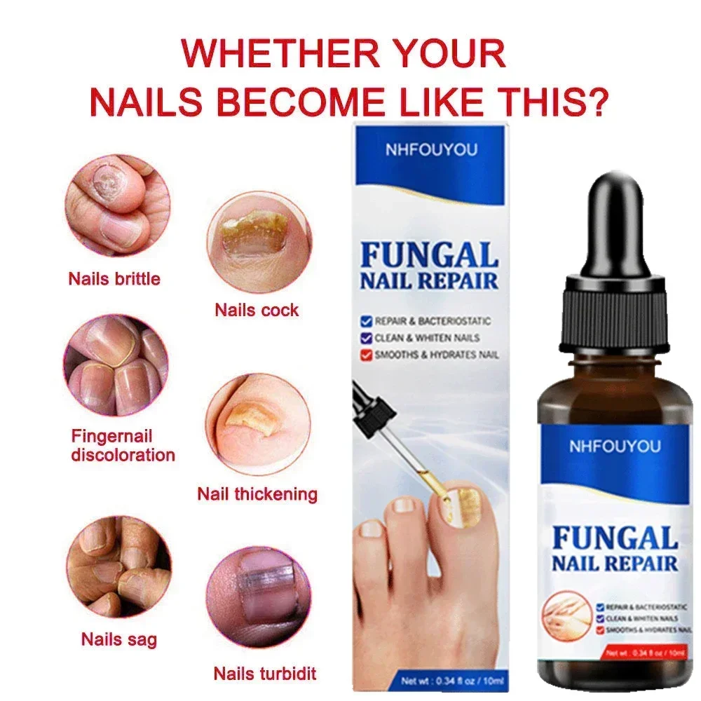 Nail Repair Líquido para Unhas descoloridas engrossadas amassadas, Fungals Renovação, Quebrado Rachado, S5F6