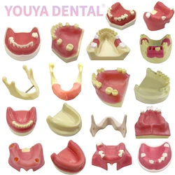 Dental Implant Practice Model Maxillary Mandibular Basic Implant Training Model With Soft Gums Suitable For Students To Practice