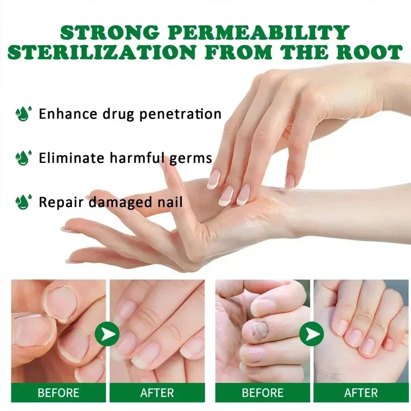 7 Day Nail Fungal Treatment Serum Foot Toe Nail Fungus Removal Essential Oil Anti Infection Onychomycosis Paronychia Repair Gel