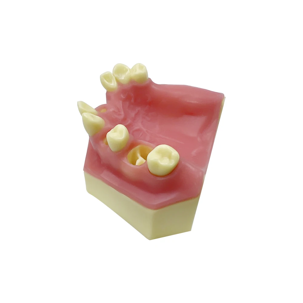 Dental Maxillary Implant Practice Model With Missing Teeth Teaching Model for Dentist Student Training Studying Tools