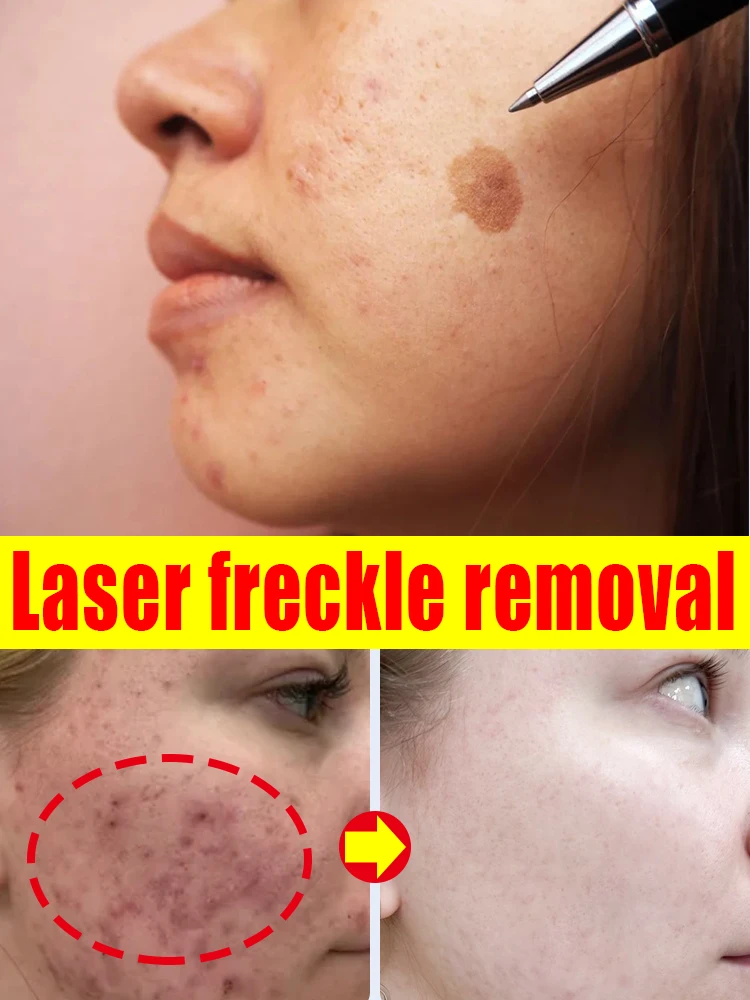 

Laser Spot Cream