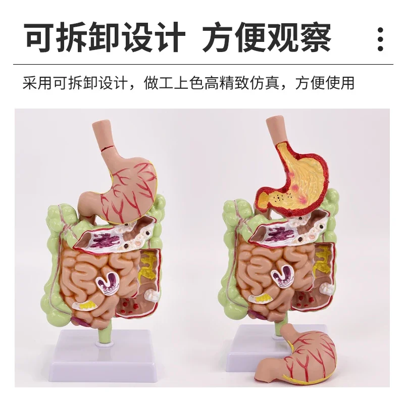 Colon pathological  Colon Gastrointestinal lesions Anatomical model Intestinal diseases Human colon lesions model