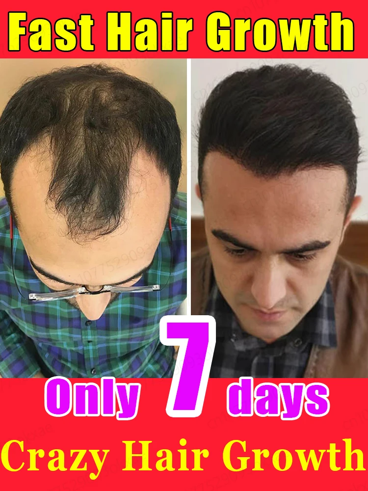 Hair growth serum for men and women, anti-hair loss, baldness, rapid regeneration, care oil, repair damaged hair, scalp treatmen