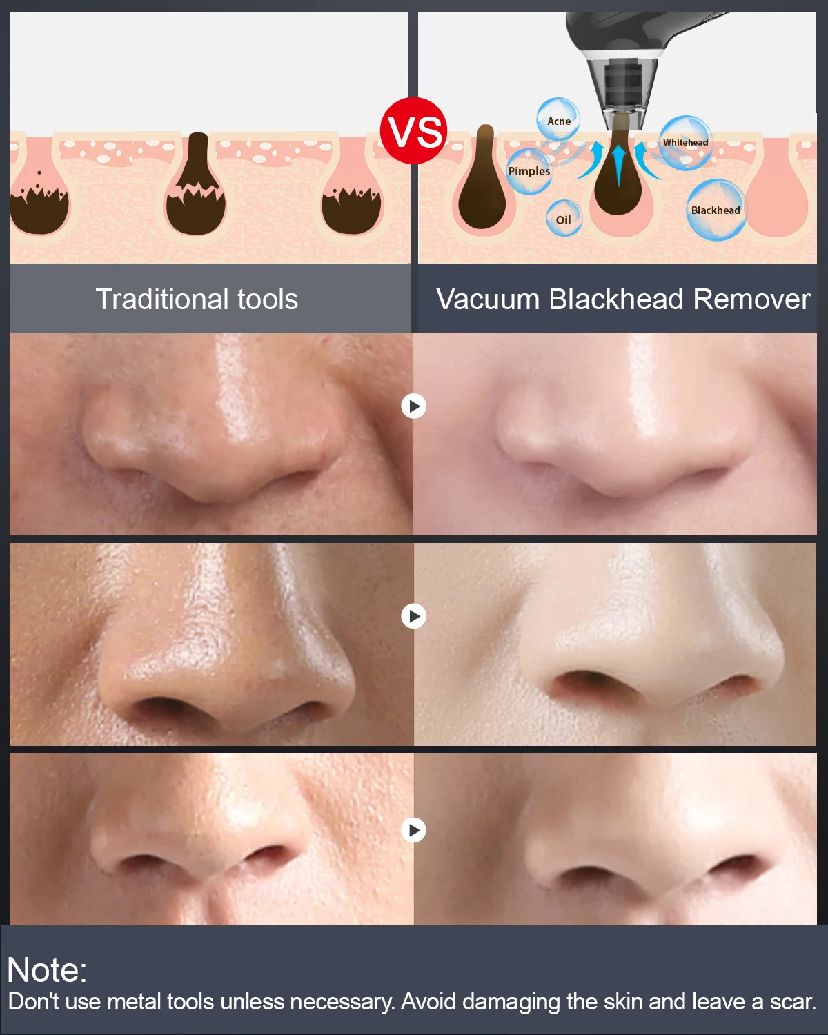 Professional Electric Blackhead Remover with Microbubble, Comedone Extractor & Blue Light - Home Facial Cleansing Device