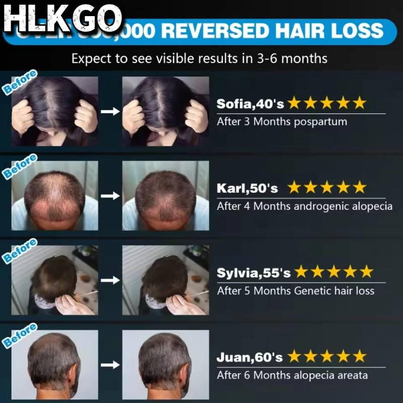 

HLKGO Professional 96 Laser Hair Cap Medical LLLT Therapy for Amazing Hair Growth & Scalp Oil Management