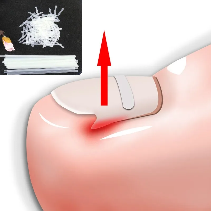 

10pcs Set of Toe Nail Groove Correction Treatment Elastic Patch Pullup Patch Anti Pull Nail Groove Patch Correction Care Tools