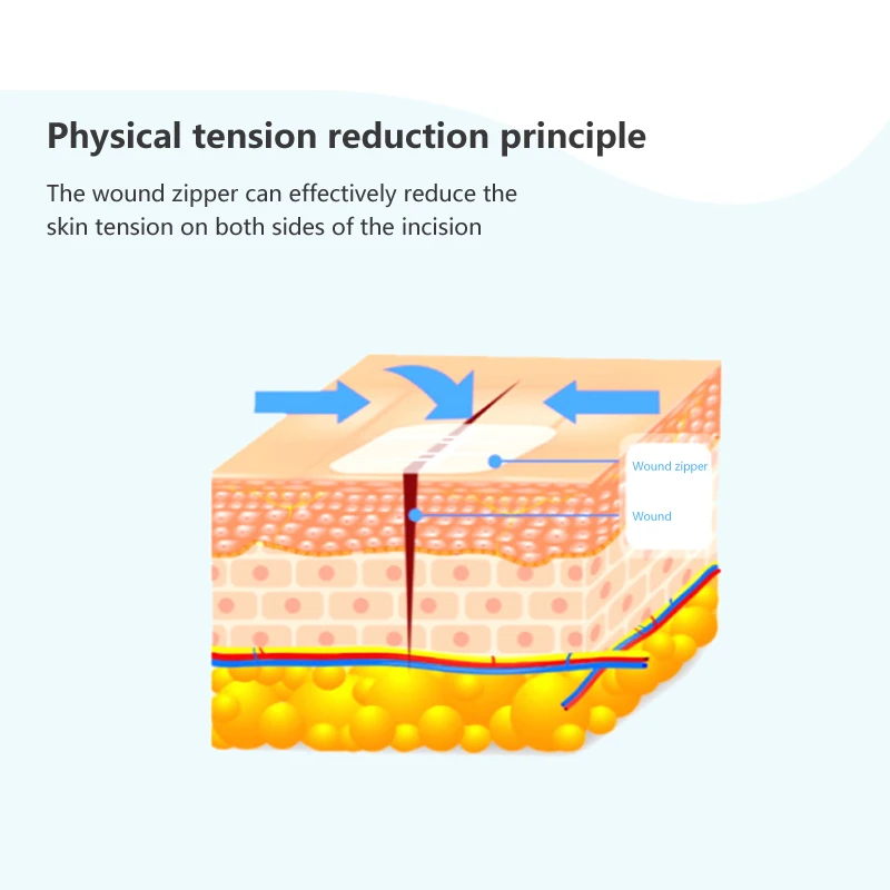 2 قطعة سستة التعادل الجرح إغلاق التصحيح مرقئ التصحيح الجرح خياطة سريعة سستة الفرقة المعونة في الهواء الطلق المحمولة إغلاق الجرح في حالات الطوارئ