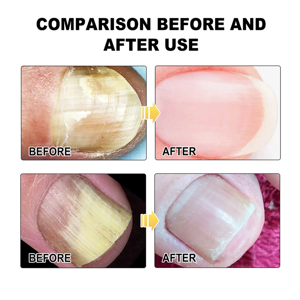 الليزر لجهاز علاج فطريات الأظافر تنظيف فطار الأظافر الفطرية إصلاح القدم الفطريات إزالة الأظافر مكافحة الفطر #1