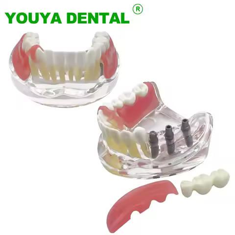 Dental Teeth Model With 3 Implants Restoration Bridge Typodont M6006 Overdenture Inferior Demo Mandibular Model Teaching Study